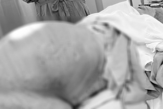 PHẪU THUẬT THÀNH CÔNG CỨU BỆNH NHÂN VỠ U BUỒNG TRỨNG, BỤNG CHỨA HƠN 15 LÍT DỊCH